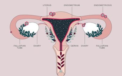 Supporting Inflamed Endometrial Tissue Naturally