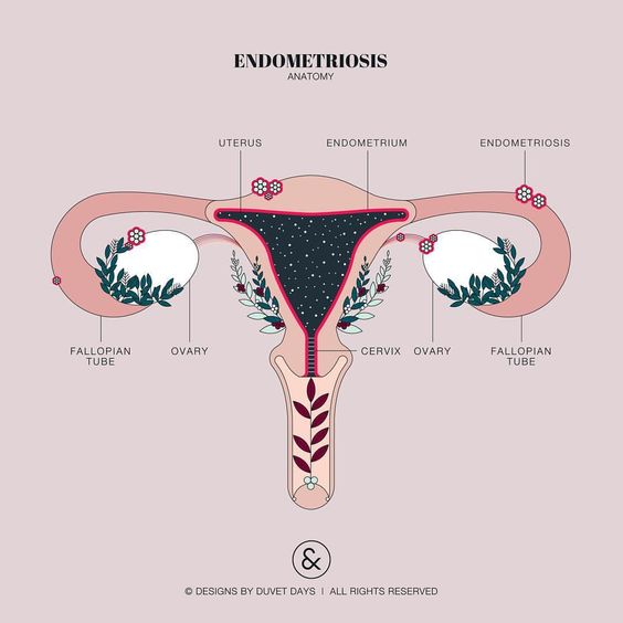 Supporting Inflamed Endometrial Tissue Naturally